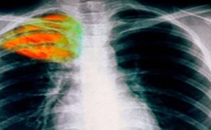 Κύπρος: 52 περιστατικά φυματίωσης το 2017 - Τι είναι και πως μεταδίδεται;