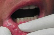Πάφος: Εκστρατεία πρόληψης κατά του Καρκίνου του Στόματος