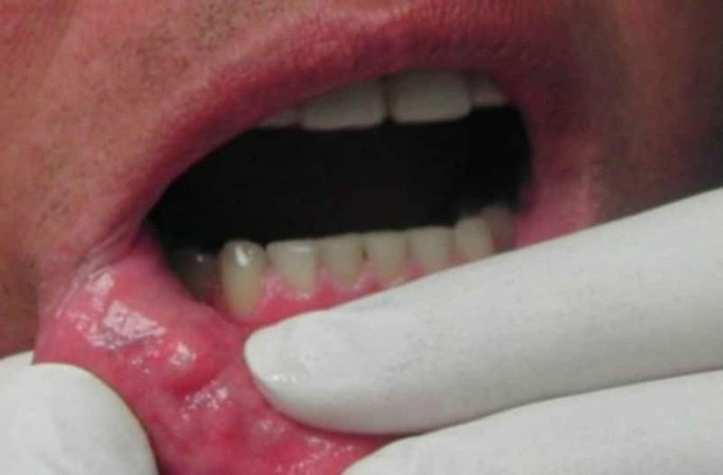 Πάφος: Εκστρατεία πρόληψης κατά του Καρκίνου του Στόματος